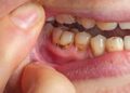 Poor oral hygiene linked to body pain, migraine in women