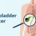 Researchers Identify Potential Blood Markers for Early Detection of Gallbladder Cancer