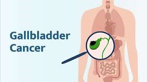 Researchers Identify Potential Blood Markers for Early Detection of Gallbladder Cancer