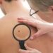 AI Identifies Early Risk Patterns for Skin Cancer
